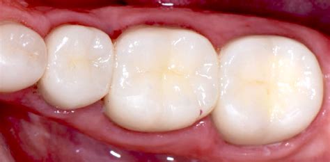 Types Of Dental Fillings Eagle Harbor Dentist