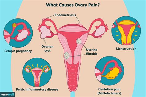 Why Do I Have Ovary Pain 11 Causes And Treatment Options