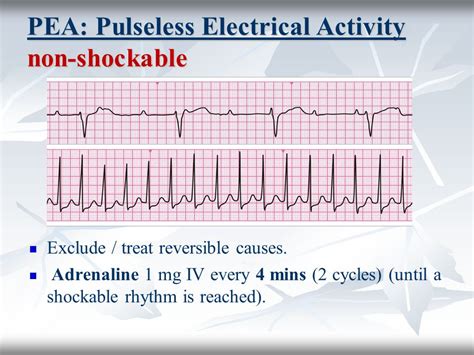dopamine for pulseless electrical activity rhythm