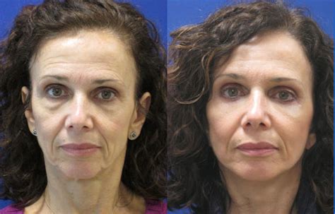 Lesley 50 Before And After Laser Assisted Lower Face And Neck Lift And