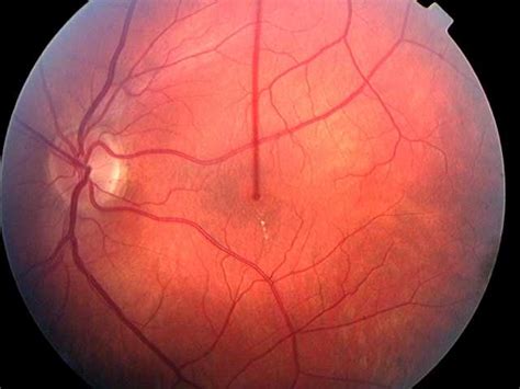 Consistent screening of diabetic retinopathy is essential in order to avoid further. are within the macular area, the picture is designated as ...