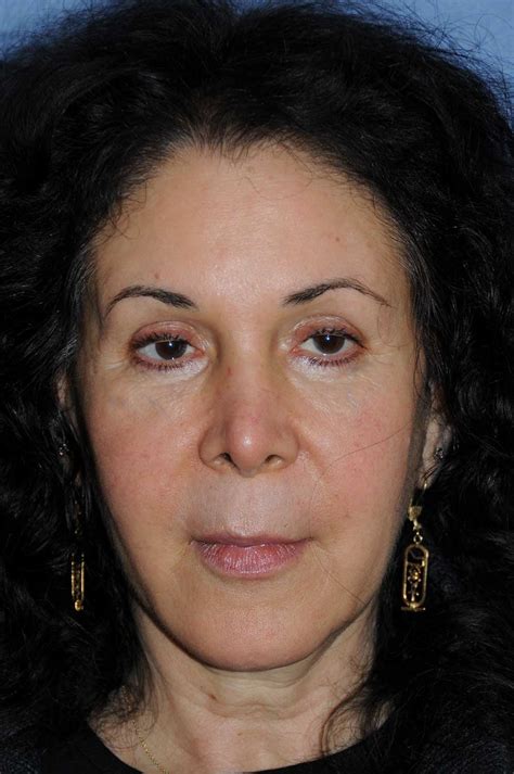 Eyelift Blepharoplasty Before And After Photos Seattle Bellevue