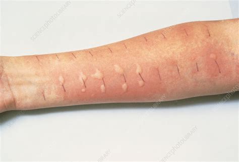 Allergy Testingpatients Arm Showing Skin Reaction Stock Image M320
