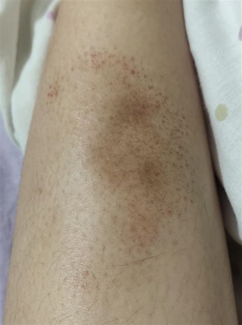 discolored skin patch with small dots on my leg could anybody help me determine what this is