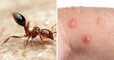 12 Common Bug Bites And How To Recognize Each One