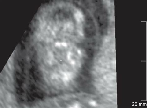 · a recent study was undertaken by researchers at king's college. Abnormal retronasal view in a 12-week fetus with absent palate and... | Download Scientific Diagram
