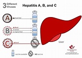 The ABC's of Viral Hepatitis | Health | greenevillesun.com