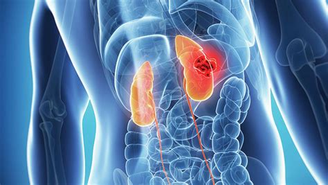 Kidney cancer is now the seventh most common cancer in the uk, accounting for three per cent of all new cancer cases. Kidney Cancer Responds to the 1-2 Punch | Georgetown ...