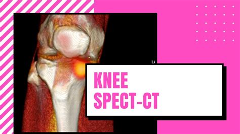 Nuclear Medicine Bone Spect Ct Knee Youtube