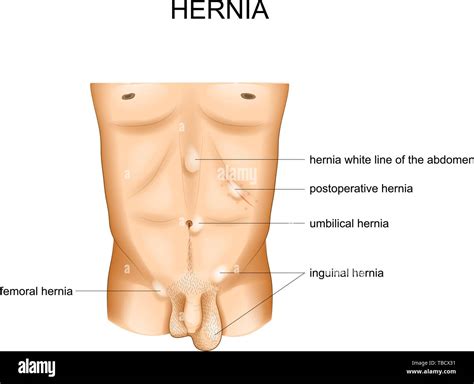 Vector Illustration Of Hernia Types By Location Stock Vector Image