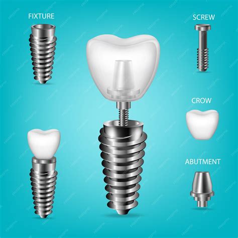 Conjunto 3d Realista Vectorial De Implantes Dentales Elementos
