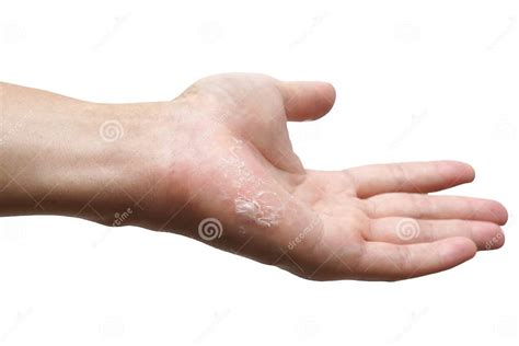 Hand Skin Peeling Stock Photo Image Of Vitamin Psoriasis 163342308