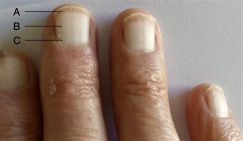 Terrys Nails • Litfl • Medical Eponym Library