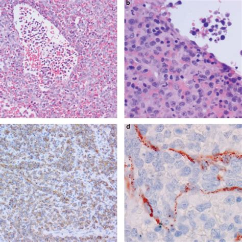 Pdf Diffuse Large B Cell Lymphoma With Distinctive Patterns Of