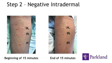 How Penicillin Allergy Testing Is Done Youtube