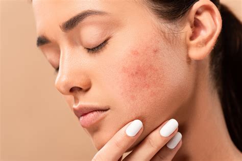 The 6 Mistakes Causing Your Acne Scars Averr Aglow Skincare