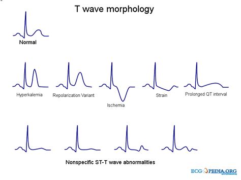 Bestandt Wave Morphologysvg Ecgpedia