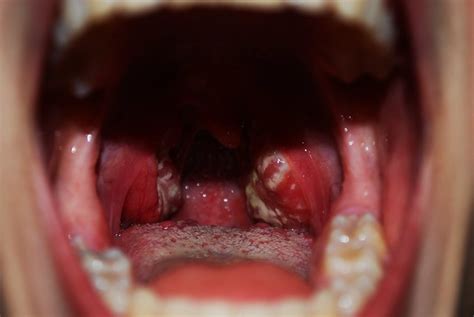 My Tonsils When I Had Mono Flickr Photo Sharing