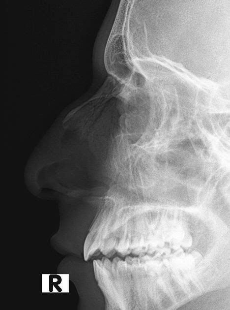 In chest, we prefer the pa view over ap view. Nasal bones - x-ray | Radiology Case | Radiopaedia.org