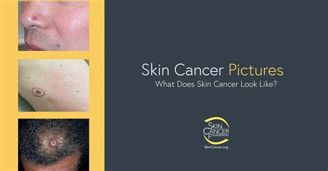What Does Skin Cancer Look Like In 2023 Dohongseo