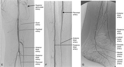 Pelvic And Lower Extremity Arteries Radiology Key