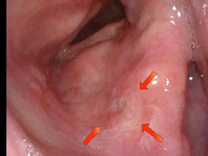 Cancer in your throat can affect your voice. Laryngeal Cancer - CLEVELAND VOICE AND SLEEP