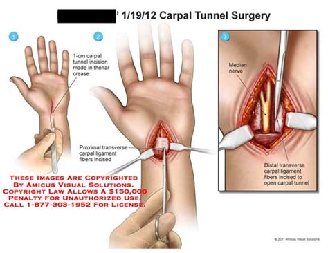 AMICUS Illustration Of Amicus Surgery Wrist Carpal Tunnel Thenar Crease Transverse Ligament