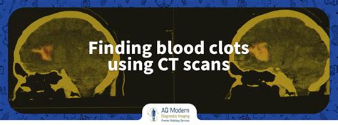 How To Find Blood Clots Using Ct Scans Blood Clot Test Aqmdi