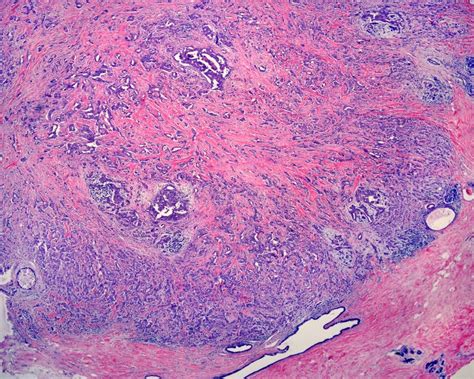 Human Breast Invasive Carcinoma Stock Image Image Of Invasive