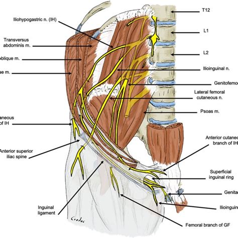 Neuropathic Inguinal Pain Due To Nerve Injury After A Laparoscopic