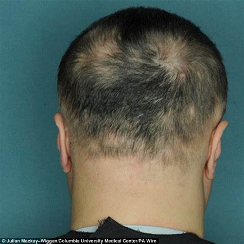Because alopecia areata cannot be cured, people who have regrowth can have more hair loss later. Pill that can cure baldness in five months - Welcome to ...