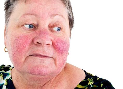 Red Itchy Face Allergic Reaction Causes Symptoms And Treatments