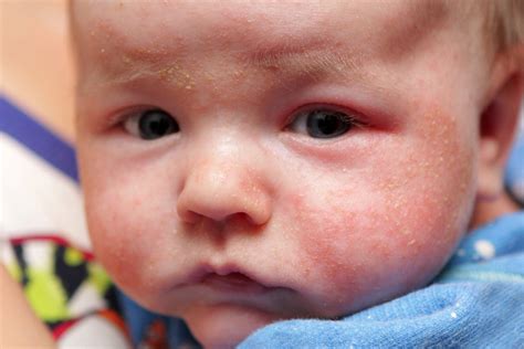 Skin Rashes In Babies Nhs