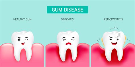 Gingivitis Inflammation Of The Gums Pathway Dentists