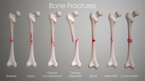 Bone Fractures Types Symptoms Treatment Vlr Eng Br