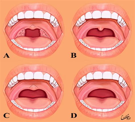 The Uvula Conditions That Dental Hygienists Can Observe During An Exam