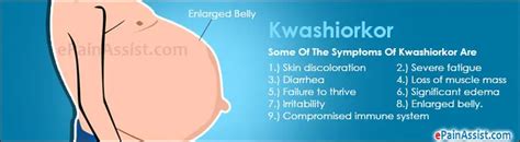 Kwashiorkor Treatment Prognosis Causes Symptoms