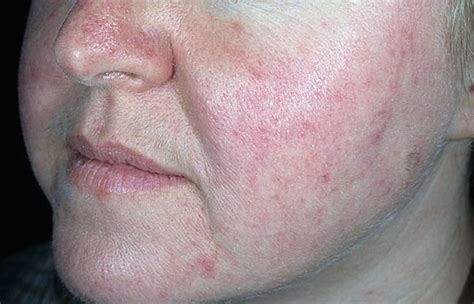 Rosacea Redness How To Manage It New Wrinkles