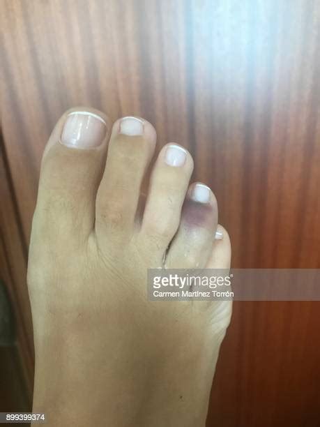 Bruised Toes Photos And Premium High Res Pictures Getty Images