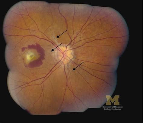 Fundus Photograph Of The Right Eye Shows Optic Nerve Head Drusen With