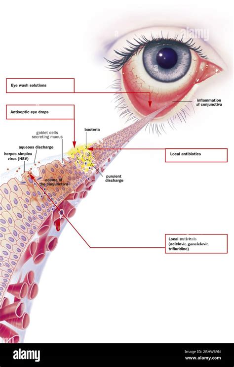 Infectious Conjunctivitis And Its Treatments View Of An Eye With