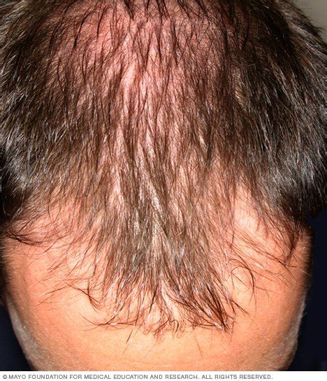 Hair Loss Disease Reference Guide Drugs