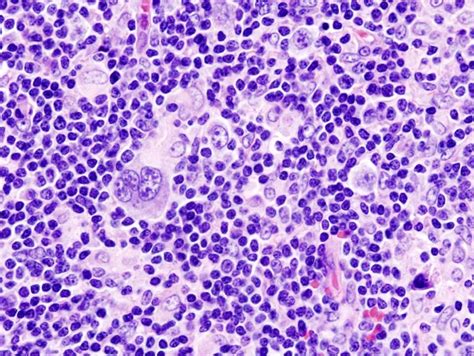 Filehodgkin Lymphoma 1 Mixed Cellulary Type Wikipedia