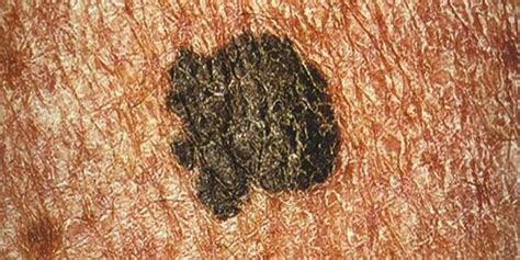 Amelanotic Melanoma Linked With Advanced Stage At Diagnosis 2 Minute