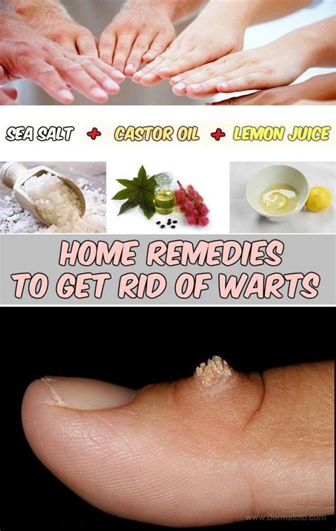 Home Remedies To Get Rid Of Warts Get Rid Of Warts Remedies Natural Home Remedies