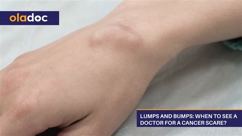 Lumps And Bumps When To See A Doctor For A Cancer Scare Healthy