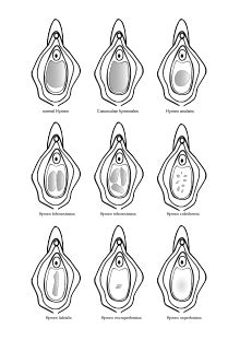 Various Types Of Hymen The Shaded Areas Represent The Vaginal Opening