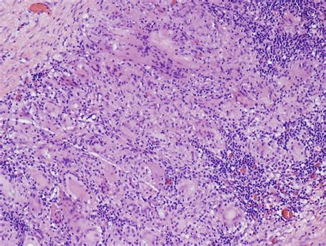 Pathology Outlines Granulomatous Cystitis