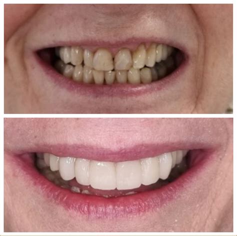 The Best Teeth Whitening Procedure Regent Dental Cambridge