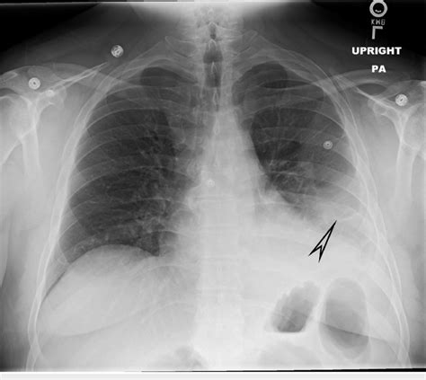 Chest X Ray Highlighting A Patchy Infiltrate In The Left Lower Lobe